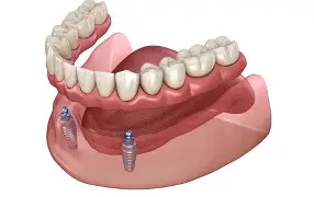 Implant Dentures