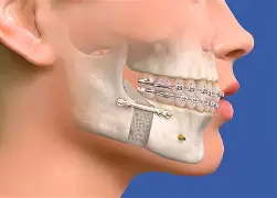 Jaw Surgery