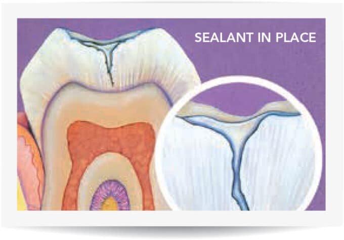 Pit & Fissure Sealant