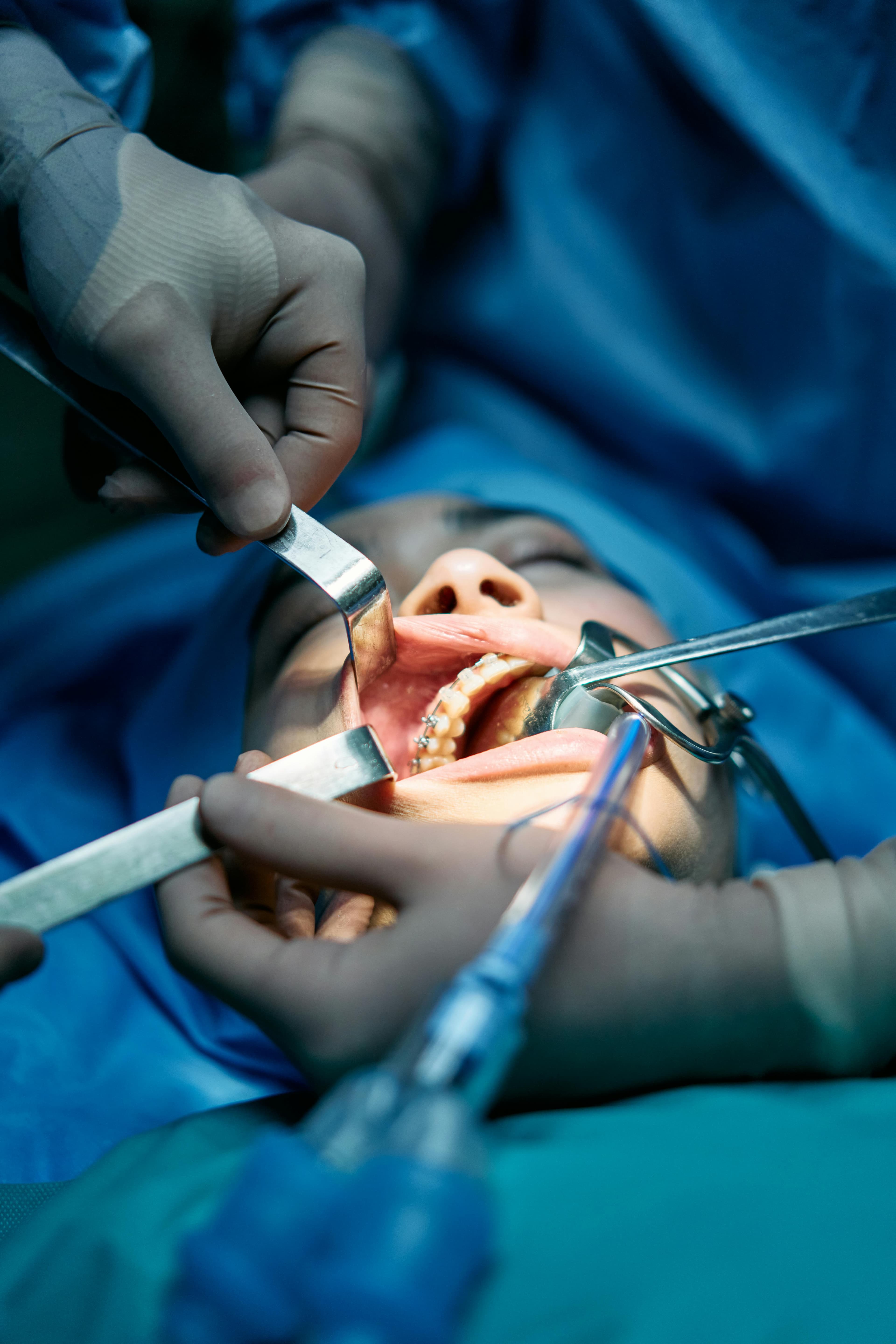 Surgical Wisdom Tooth Removal